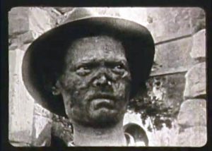 Πορτραίτο χανσενικού από τη Σπιναλόγκα. Οι αλλοιώσεις στο πρόσωπο έδιναν αποκρουστική εικόνα.... 